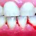 bleeding in gum