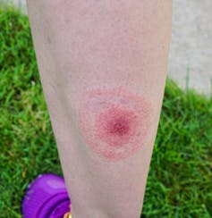 A bull's-eye shaped rash on a person's lower leg