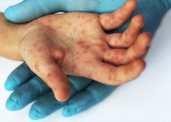 Measles: global increase in cases likely driven by COVID pandemic