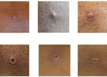 Monkeypox Q&A: how do you catch it and what are the risks? An expert explains