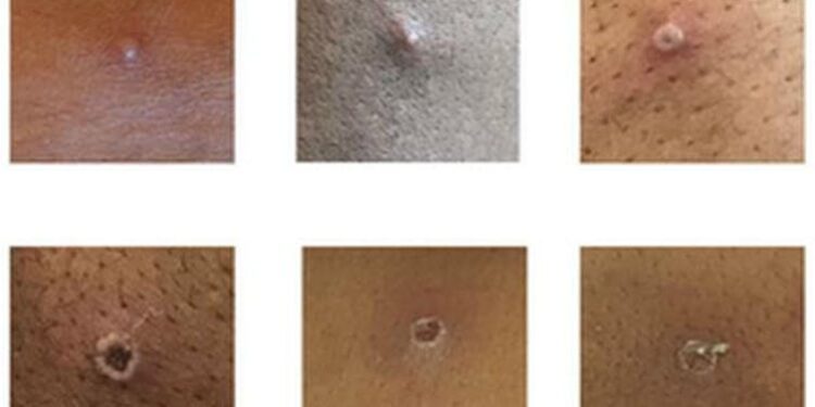 Monkeypox Q&A: how do you catch it and what are the risks? An expert explains