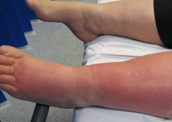 What’s cellulitis? A dermatologist explains