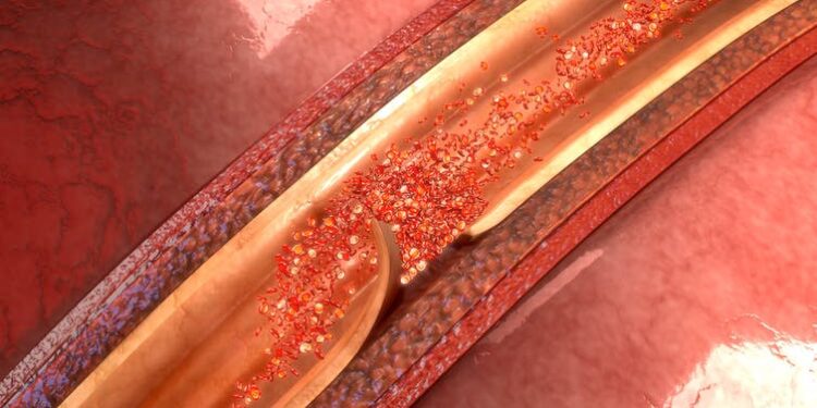 Depeche Mode keyboardist Andrew Fletcher died of an aortic dissection – here’s what it is