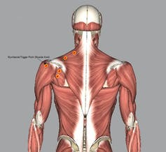 Model of adult person's musculature with red dots showing potential locations for muscle knots