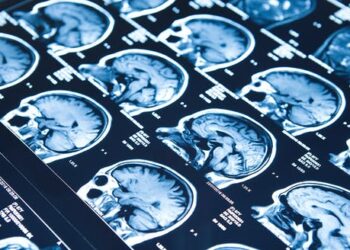 What epilepsy teaches us about diversity and resilience