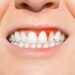 Four health conditions linked to gum disease