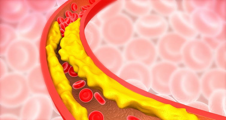 A digital illustration showing yellow plaque sticking to the walls of the arteries.
