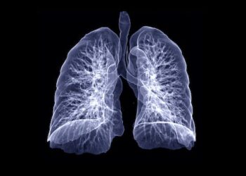 COVID-19 can cause lasting lung damage – 3 ways long COVID patients’ respiration can suffer