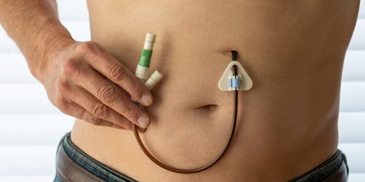 Parkinson’s disease: treatment is best started early