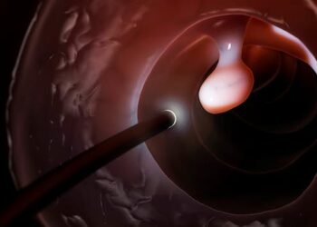 Colonoscopy is still the most recommended screening for colorectal cancer, despite conflicting headlines and flawed interpretations of a new study