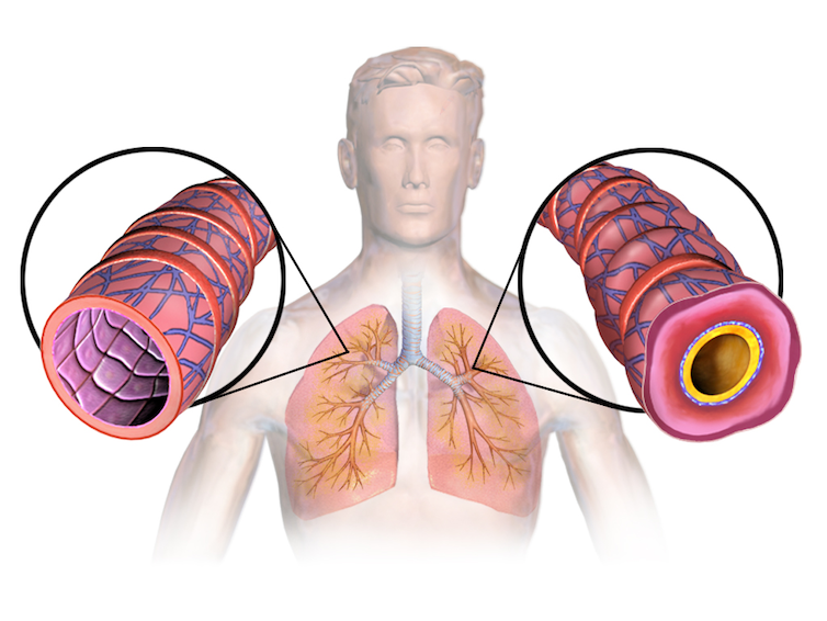 A diagram of a man showing two airways, one open and the other more constricted.