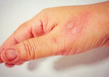 What is inflammation? Two immunologists explain how the body responds to everything from stings to vaccination and why it sometimes goes wrong