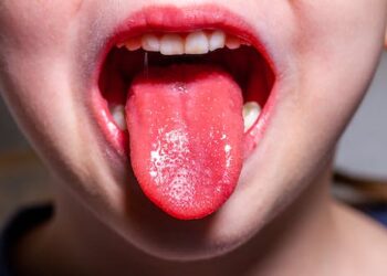 Scarlet fever outbreak in Scotland: what you need to know