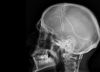 Treating mental illness with electricity marries old ideas with modern tech and understanding of the brain – podcast