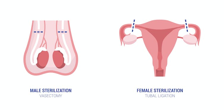 Illustrated anatomical examples of vasectomy on the left and tubal ligation on the right.