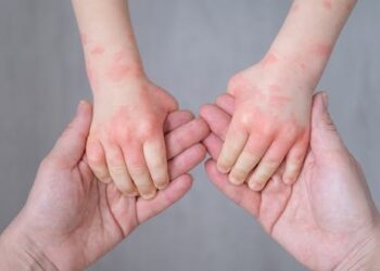 Cold weather brings itchy, irritated, dry and scaly skin – here’s how to treat eczema and other skin conditions and when to see a doctor