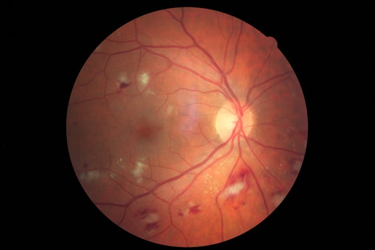 photograph of a fundus