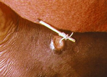 Guinea worm: A nasty parasite is nearly eradicated, but the push for zero cases will require patience