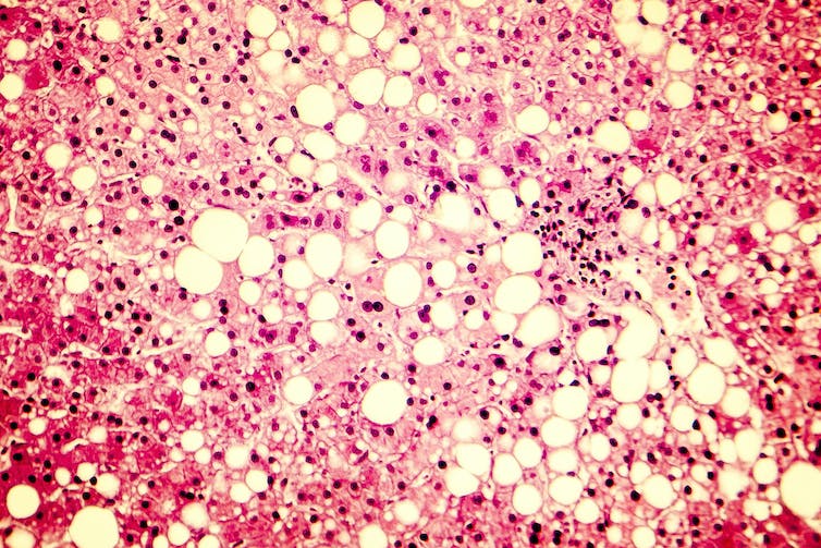 A light micrograph image of fatty liver, with large vacuoles of triglyceride fat accumulated inside liver cells.
