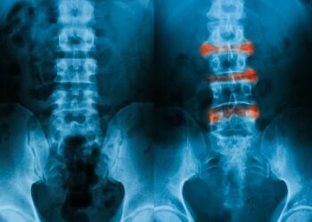 Ankylosing spondylitis: machine learning could pave the way for early diagnosis of inflammatory arthritis