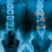 Ankylosing spondylitis: machine learning could pave the way for early diagnosis of inflammatory arthritis