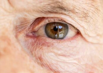 Can you really ‘address’ annoying eye floaters with a supplement?