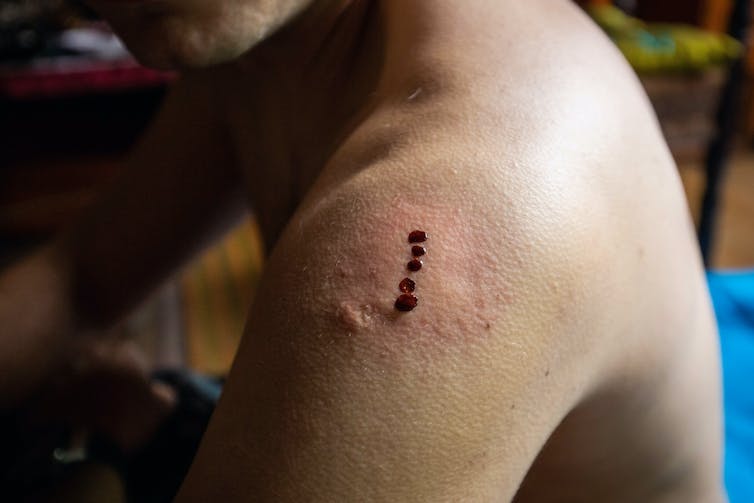closeup of five dots of blood on the shoulder of a man without a shirt