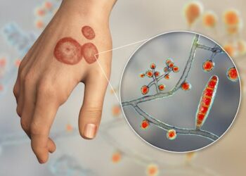 Ringworm fungal infections are common in the US and are becoming increasingly resistant to treatment – 6 questions answered