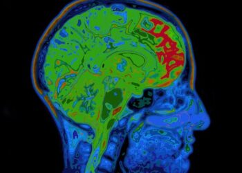 People with obsessive-compulsive disorder have an imbalance of brain chemicals – our discovery could mean a treatment breakthrough