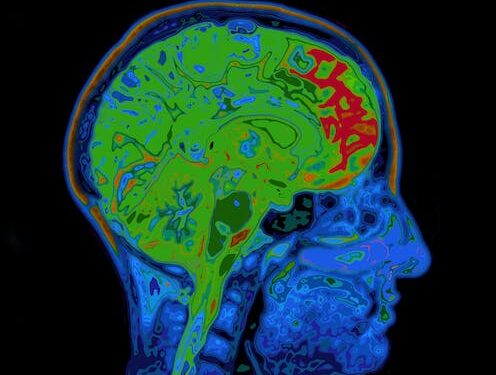 People with obsessive-compulsive disorder have an imbalance of brain chemicals – our discovery could mean a treatment breakthrough