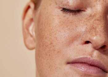 Acne bacteria trigger cells to produce fats, oils and other lipids essential to skin health – new research