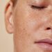 Acne bacteria trigger cells to produce fats, oils and other lipids essential to skin health – new research