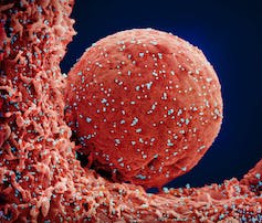 Microscopic view of a cell infected with SARS-CoV-2, appearing as a large red ball dotted with green virus particles