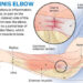 The Ultimate Guide for Tennis Elbow