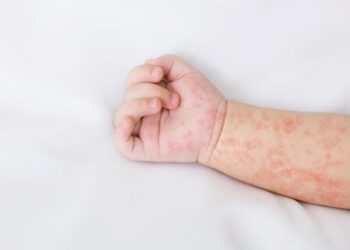 Protecting communities: The urgency of vaccinating to prevent a measles resurgence