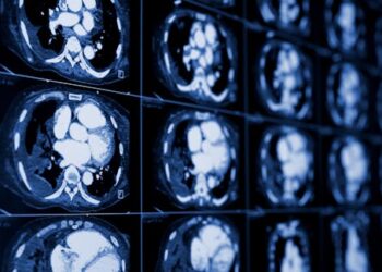 Lung cancer is the deadliest of all cancers, and screening could save many lives − if more people could access it