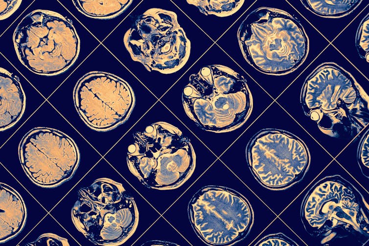 A sheet of brain scans.