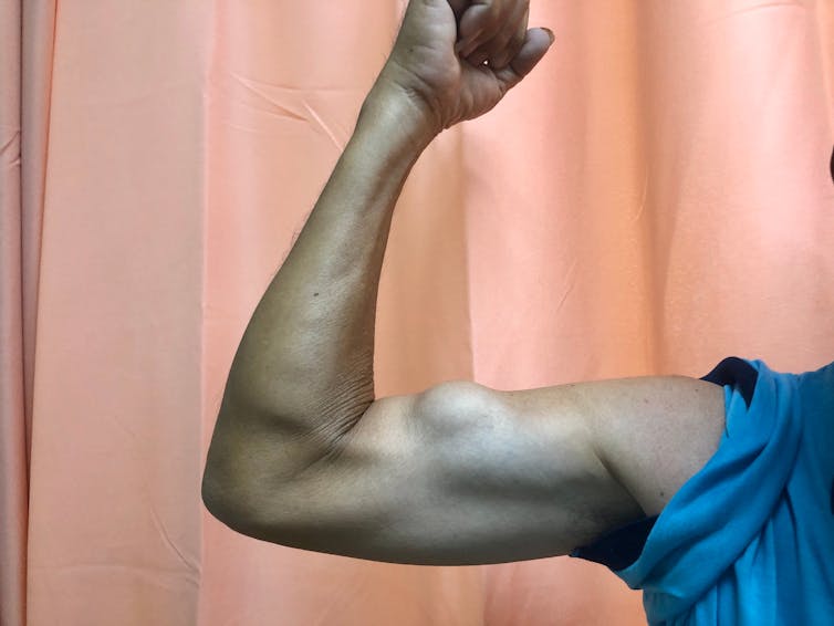 A man with a bulging bicep muscle caused by a bicep tear.
