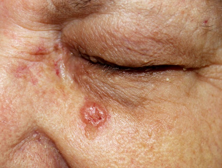 A basal cell carcinoma on an elderly person's cheek.