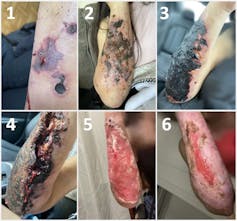 Grid of six images showing progression of a xylazine-associated wound on person's forearm