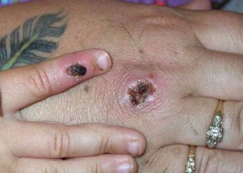 What is mpox? A microbiologist explains what’s known about this smallpox cousin