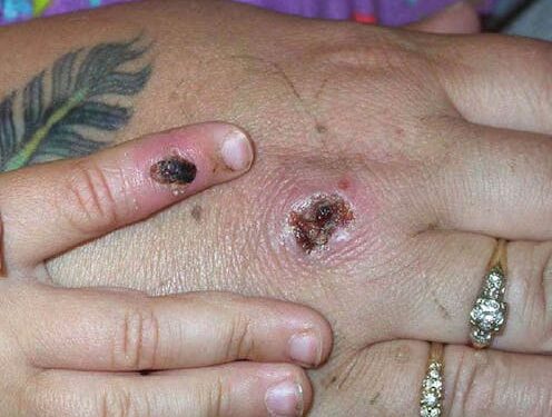 What is mpox? A microbiologist explains what’s known about this smallpox cousin