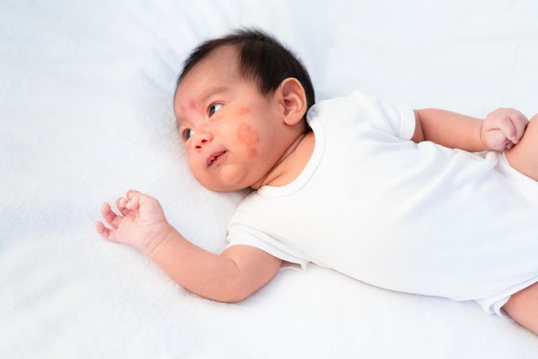 An infant in a white onesie with a red rash on the face