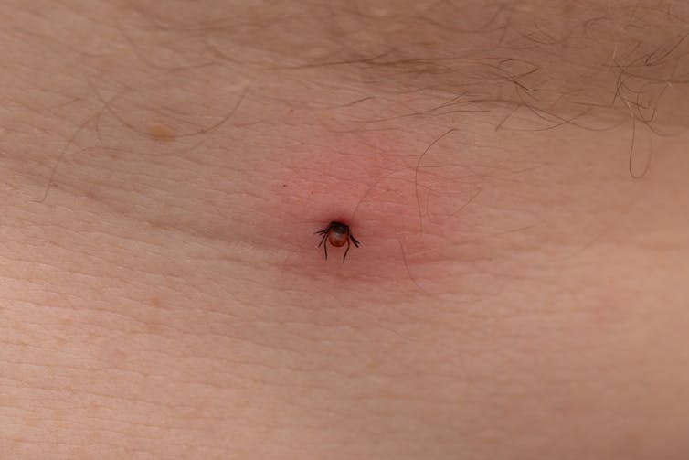 A tick embedded into a person's skin.