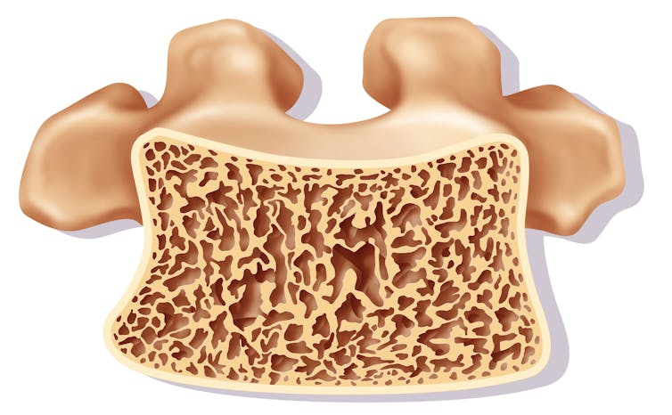 An illustration of osteoporosis of the spine, which features sponge-like, brownish tissue.