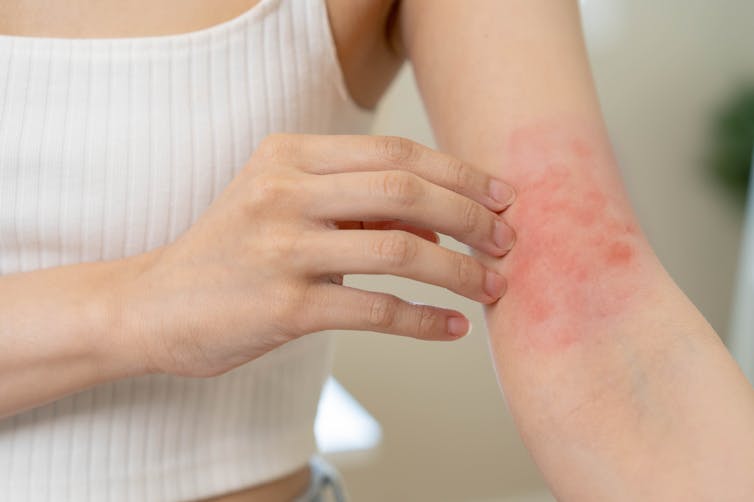 A woman scratches the red patch of eczema on her arm.