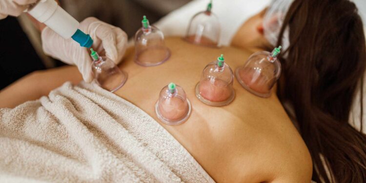 Is Cupping Right for You? Everything To Know About Its Benefits and Risks