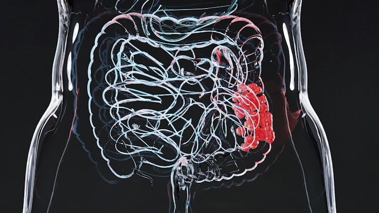 A digital drawing depicting a cancerous tumour inside a person's bowels.