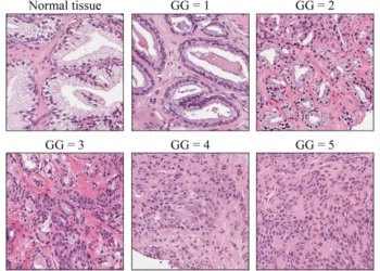 What does it mean for Biden’s prostate cancer to be ‘aggressive’? A urologic surgeon explains