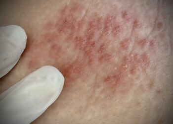 Shingles vaccination rates rose during the COVID-19 pandemic, but major gaps remain for underserved groups